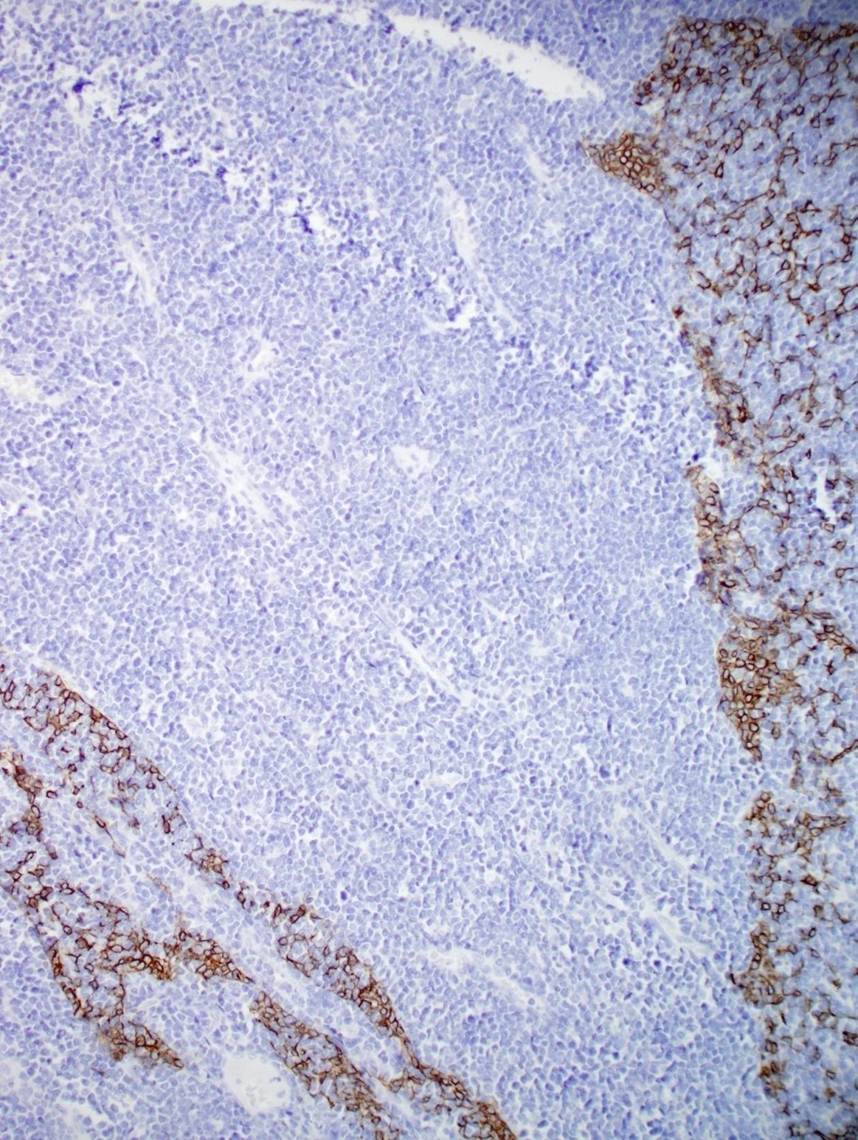 Cytokeratin cocktail immunostain of mediastinal mass